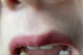 整牙的过程。太酸痛了图片