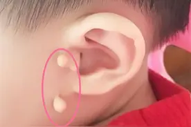 耳边多“肉揪”，孩子理发被嘲笑，耳有“拴马桩”是福气的象征？图片