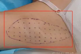 12岁狐臭女孩，运动后臭味就加重？皮肤科主任：这样治疗有帮助图片