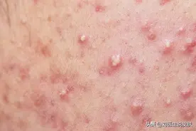 皮肤病涂的含激素软膏，安全吗？你至少要知道这2点图片