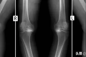 膝关节为什么会变形？膝盖变形是什么原因导致的？图片