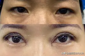 做个眼综合双眼皮开内眼角术前术后能有多大变化？来看看真人案例图片