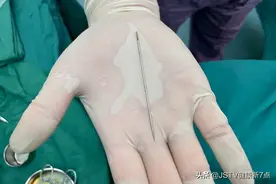 家长太大意 13岁男孩的尿道里竟取出一根近9厘米的钢针图片