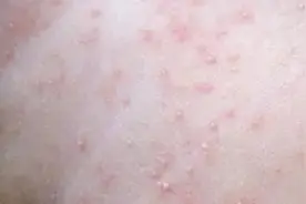 孩子身上最近起了红疙瘩，总忍不住想挠？可能是长痱子了图片