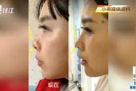 完脂肪填充 姑娘整容手术却把自己360度无死角鼻子“毁了”（一）视频封面