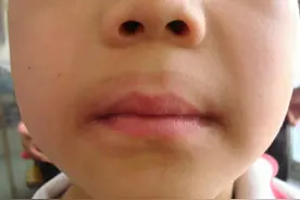 儿童口周出现淡淡的黑圈，干燥红斑、皲裂和脱屑，可能是舌舔皮炎图片