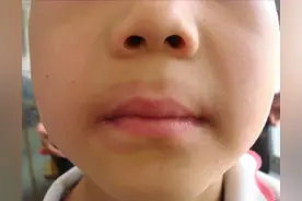 儿童口周出现淡淡的黑圈，干燥红斑、皲裂和脱屑，可能是舌舔皮炎图片