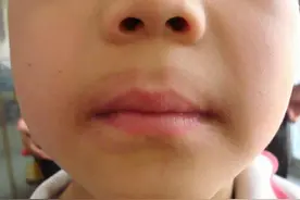 儿童口周出现淡淡的黑圈，干燥红斑、皲裂和脱屑，可能是舌舔皮炎图片