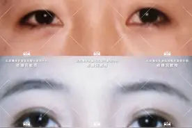 我适合哪种类型的双眼皮？图片