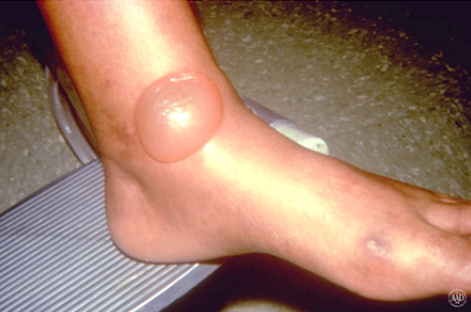 角化过度角化不全炎症