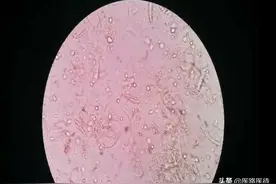 滴虫性阴道炎图片