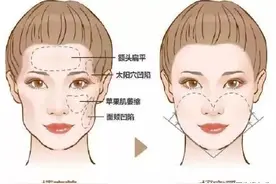 做了“自体脂肪填充面部”后，千万不能变胖？图片