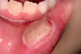 ​口腔问题都是大问题，口腔溃疡怎么办，这些小妙招来帮你图片