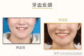 长沙牙套正畸：什么是反颌（地包天），附反颌案例展示图片