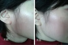 女生在美容机构做脱毛后，右脸颊出现硬币大小红斑，三个月还未消退图片