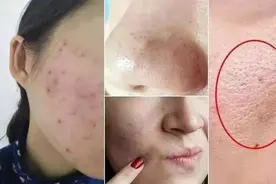 李佳琦也推荐的网红洁面皂，能去黑头闭口，让肌肤变细腻白嫩图片