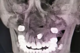 智齿到底拔不拔？图片