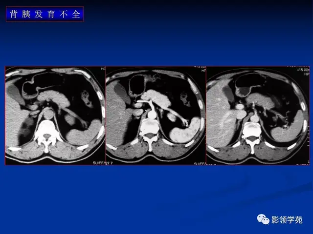 胰腺的解剖与常见变异