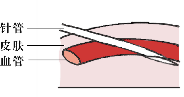 辟谣：输液好得快、通血管？输液的10个真相，一次说清