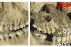 女子烤瓷牙出问题却不痛不痒，直到脸上肿起大包才知遭殃！2次手术后成了这样图片
