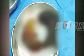 太可怕！广东8岁女孩腹痛难忍，一查惊呆：体内竟有一团密密麻麻的头发…图片