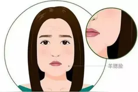 “羊腮脸”做拉皮手术，术后这张脸“太好看”了图片