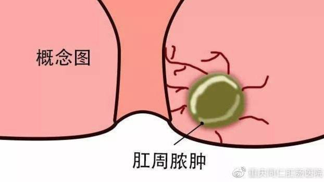 肛周脓肿要手术吗？