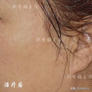 小腿脂溢性角化病