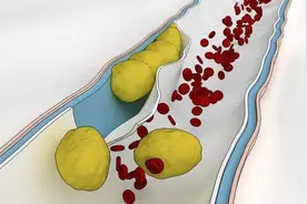 低密度脂蛋白胆固醇升高最好少吃什么？听听药师怎么说图片