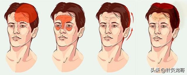 从头部经络的循行来区分头痛的类型,针灸取穴依据及特效引经草药