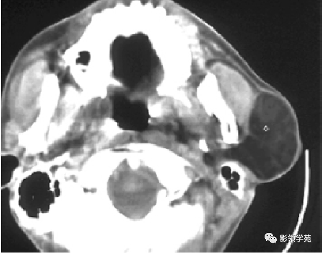腮腺角化型鳞癌