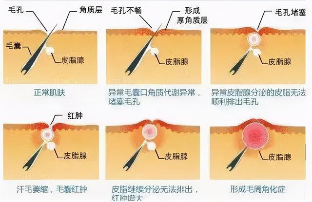 鸡皮肤来看一招改善没那么难