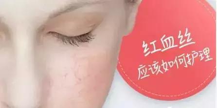 红血丝皮肤的保养 红血丝皮肤如何保养 红血丝皮肤的保养 红血丝皮肤如何保养