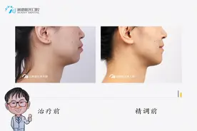 【每周案例：隐适美拔牙矫治嘴突】图片
