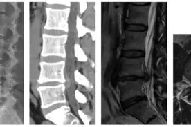 关节镜也能治疗脊柱疾患！ 微创技术跨界融合，解决腰椎间盘突出难题图片