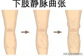 下肢静脉曲张与运动锻炼图片