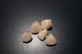 不小心磕掉了牙齿，该怎么办？图片