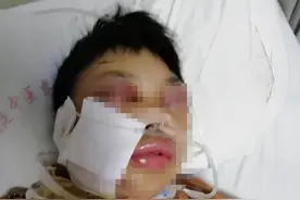 小心，蛇出没！半个月福建多人被“放倒”！女子头部被咬后，脸肿变形险丧命图片