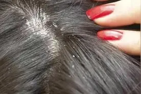 为什么经常洗头发，还有许多头皮屑？极有可能是这2点被你忽视了图片