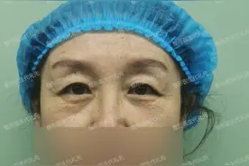 57岁眼周年轻化手术术前术后对比，公开6点细节感受图片