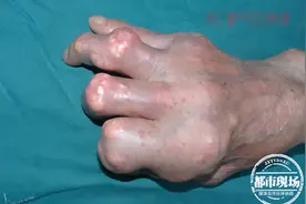 6旬老人手脚长满“石头”，严重变形！医生刮骨十几小时清除图片