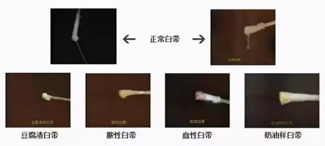 什么样的白带算正常？白带的“量、性、味”怎么判断？