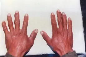 关于大骨节病，你了解多少？图片