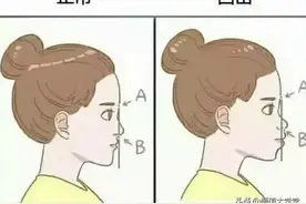 形成凸嘴的原因有哪些？怎么让凸嘴不明显？图片