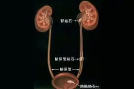 得了尿路结石，你应该知道的那些事儿呢？图片