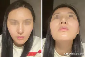 多次鼻修复，耳软骨取没了，鼻子歪得厉害，我该怎么办？图片