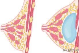 #安心变美课堂##我的安心变美推荐# 【 注意了！！！其实，假体隆胸比你想象中要安全！】图片