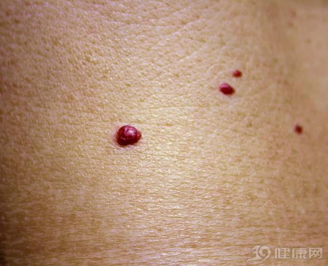 皮肤出现小红点不痛不痒