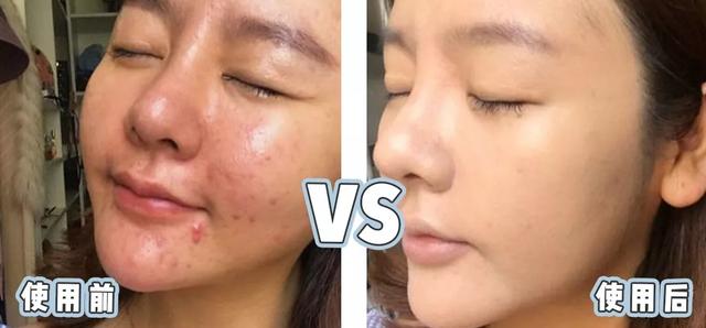 涓嶅埌鐧惧厓鐨勬皑鍩洪吀娲楅潰濂讹紝鑷甫娲侀潰鍒峰ご锛岀毊鑲よ秺娲楄秺婊戞簻