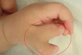 产妇生出“猪蹄宝宝”，宝妈称是吃多了猪蹄，医生：和宝爸有关图片
